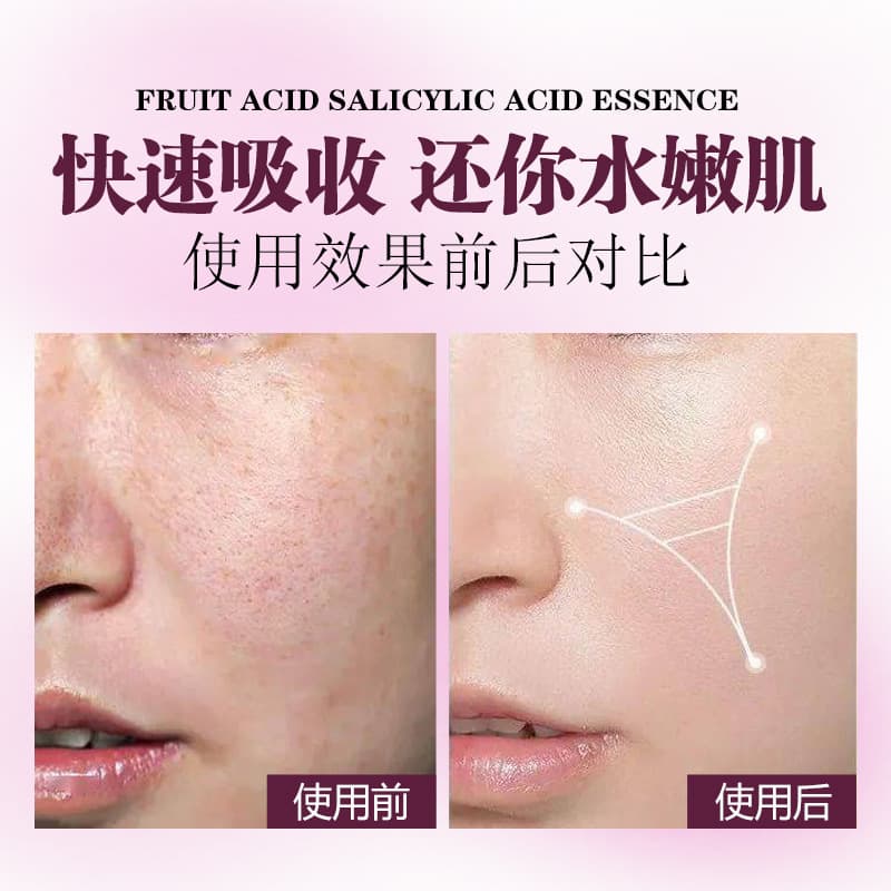 Fruit acid salicylic acid essence removes acne, softens cuticles, malic acid refines pores, shrinks pores, hydrates and moisturizes 5