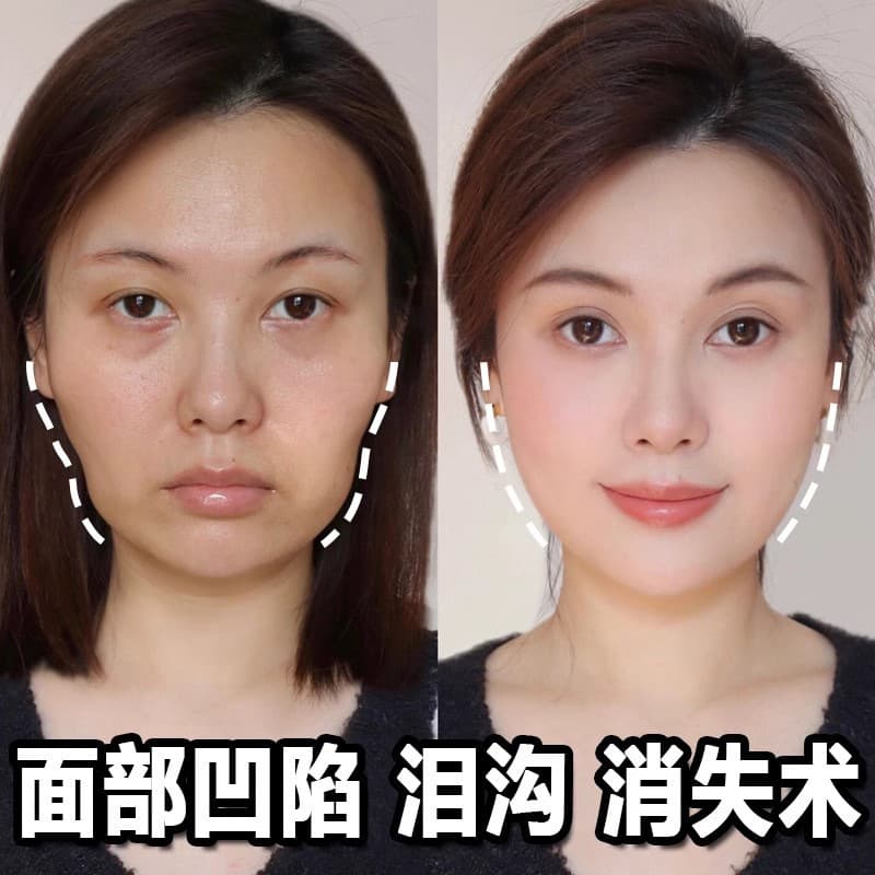 Facial plumping serum, beauty salon temple tear trough supplement, facial plumping essence, genuine wholesale original solution 1