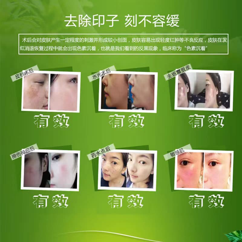 Postoperative repair factor for beauty salon spots and spots and tattoos embroidered scars and scalds water and light skin facial repair growth peptide 2