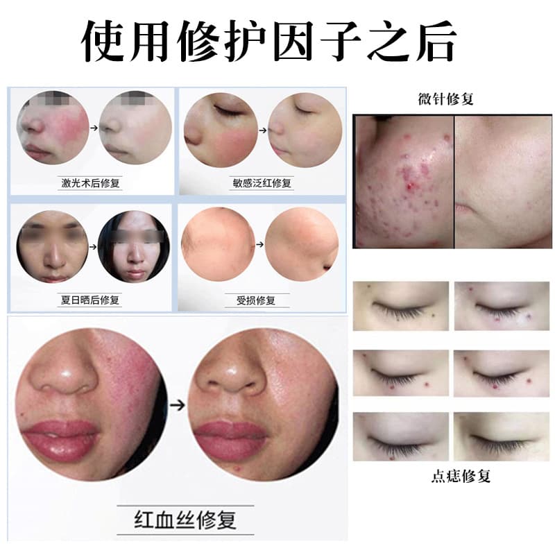 Postoperative repair factor for beauty salon spots and spots and tattoos embroidered scars and scalds water and light skin facial repair growth peptide 4