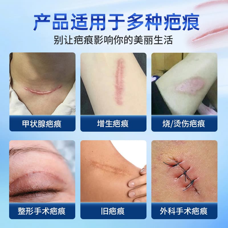 Beijing Tongrentang Medical Silicone Gel Scar Repair Sticker Burn Burn Hypertrophy Stretch Mark Postoperative Scar Sticker Hair 2