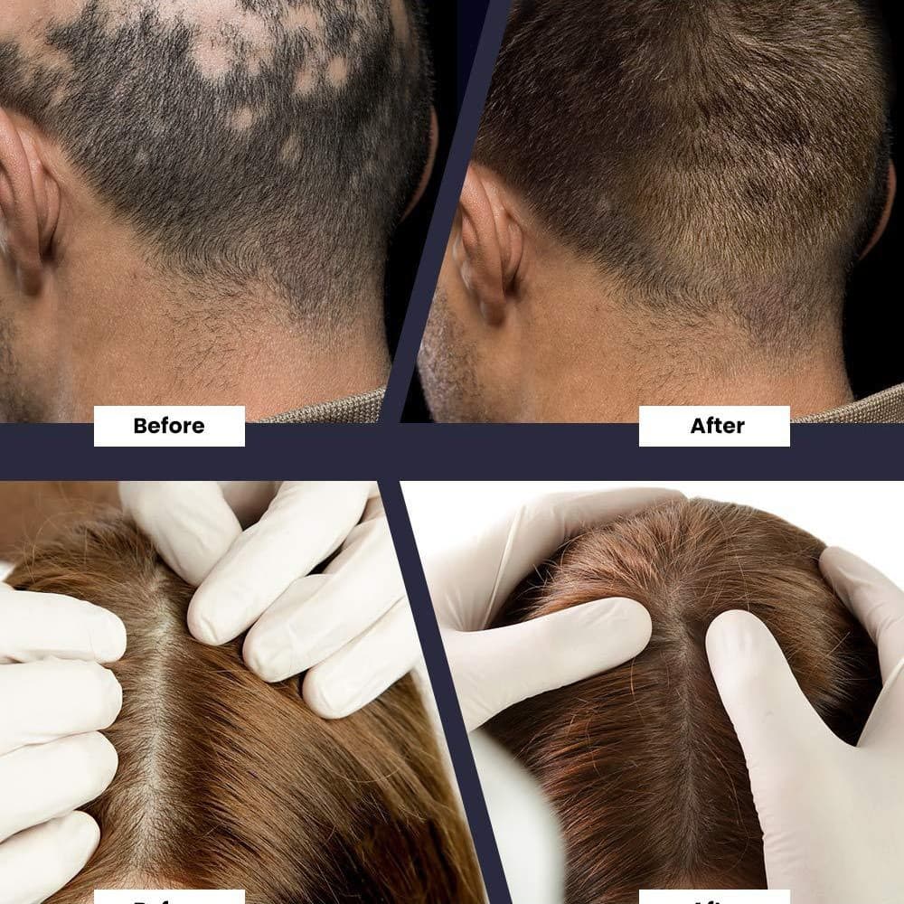 Hair Growth Serum - Seborrheic Hair Loss Treatment 4