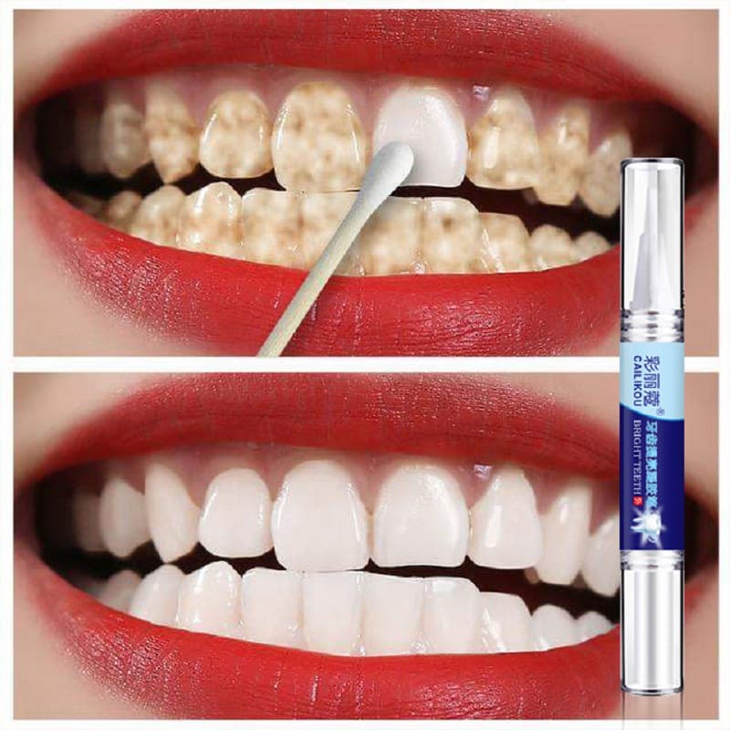 Teeth Whitening Pen - Fast Stain & Yellow Teeth Removal